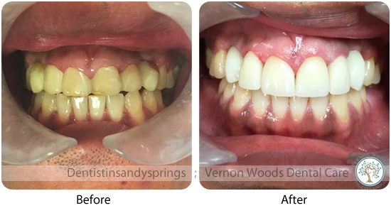 Vernon Woods Dental Implant Center | Piezo Ultrasonic Scaler, Preventative Program and Oral Exams