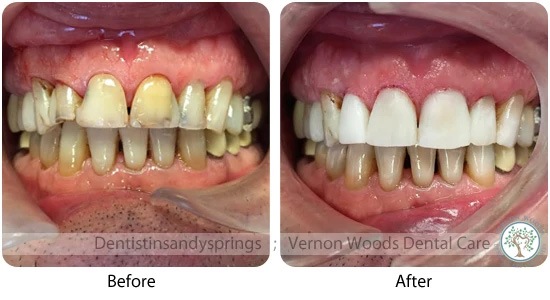 Vernon Woods Dental Implant Center | Ceramic Crowns, CBCT and Root Canals