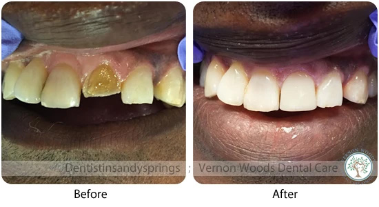 Vernon Woods Dental Implant Center | Teeth Whitening, Night Guards and Fluoride Treatment