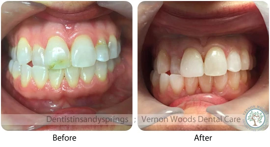 Vernon Woods Dental Implant Center | Botox reg , Teeth-In-A-Day and Root Canals
