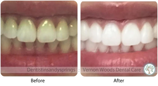 Vernon Woods Dental Implant Center | Digital Impressions, Implant Dentistry and Dental Sealants