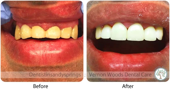 Vernon Woods Dental Implant Center | Teeth-In-A-Day , Veneers and Bone Grafts