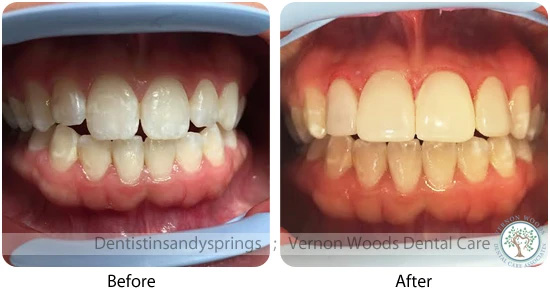 Vernon Woods Dental Implant Center | CBCT, Sports Mouthguards and Bone Grafts