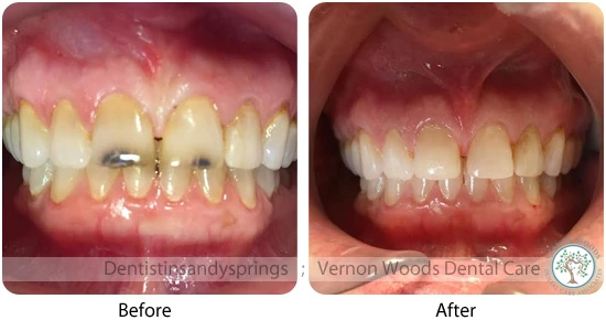 Vernon Woods Dental Implant Center | Fluoride Treatment, Botox reg and Piezo Ultrasonic Scaler